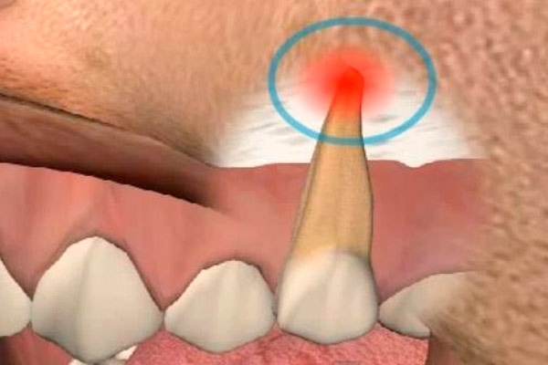Гранулема зуба: что это такое, причины ее возникновения, методы лечения