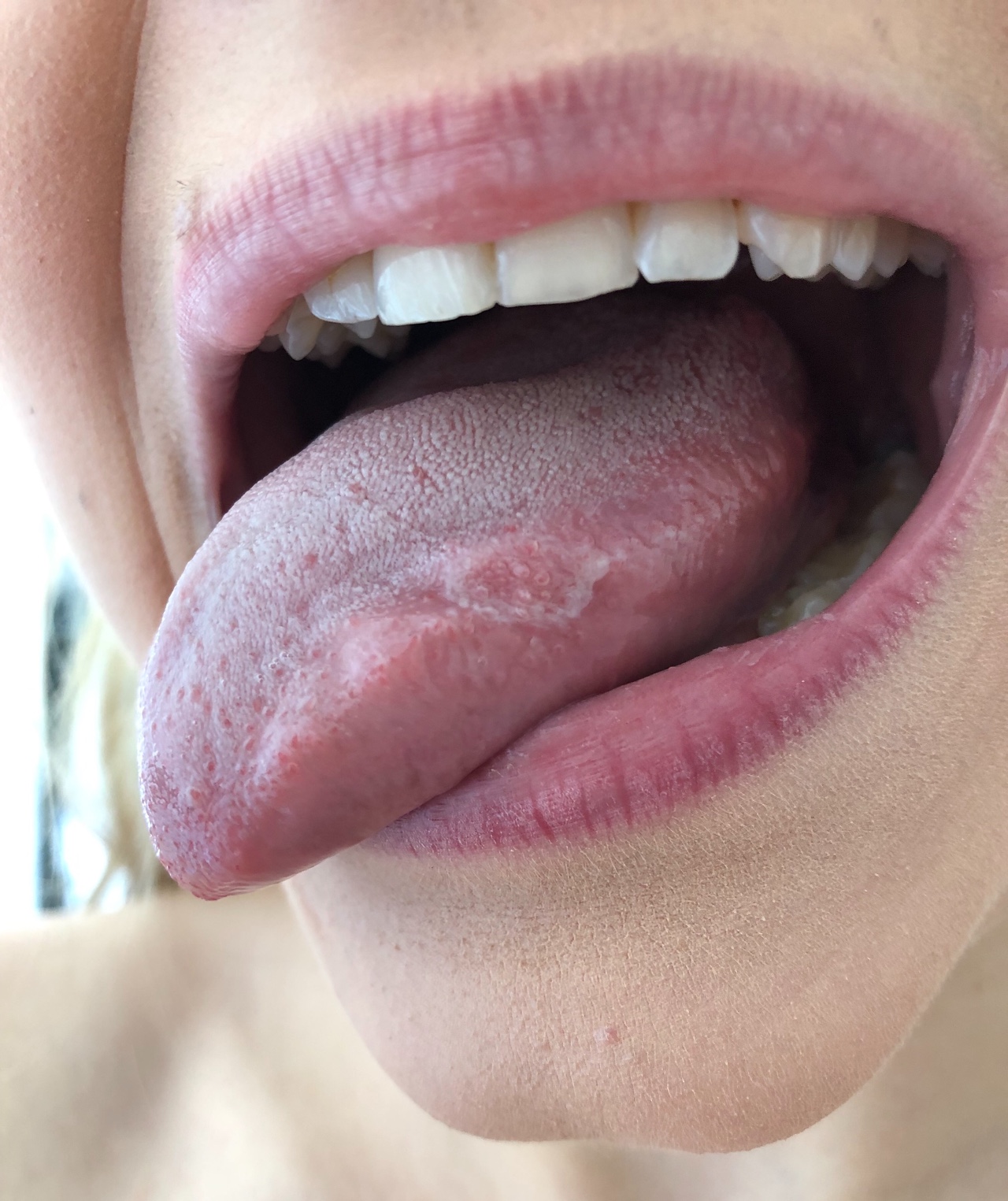 Стоматологи рассказали, как выявить по языку серьезные заболевания