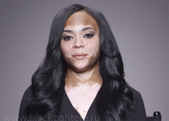 http://www.blackpantera.ru/images/health/vitiligo-na-lice.jpg