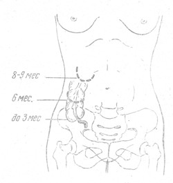 Яичники и аппендикс где находятся у женщины. Расположение аппендикса у беременных. Аппендицит у беременных расположение. Расположение кишечника у беременной женщины. Расположение яичников у женщин.