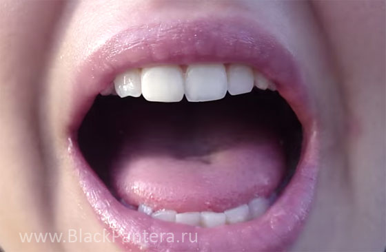 Глоссит