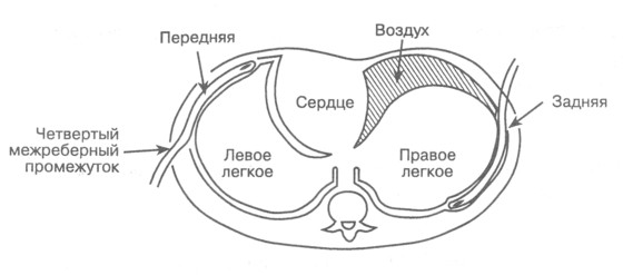 Расположение дренажной трубки при дренаже грудной клетки