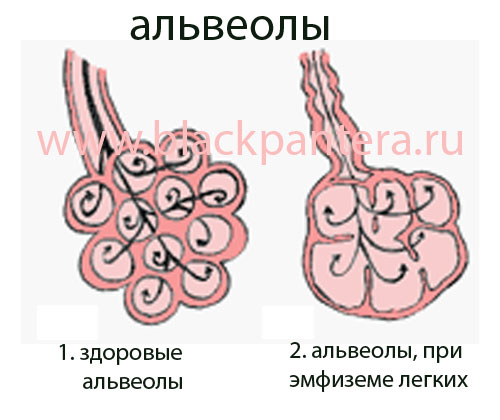 Эмфизема легких