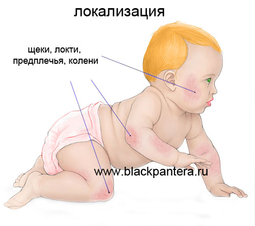 Локализация атопического дерматита у детей