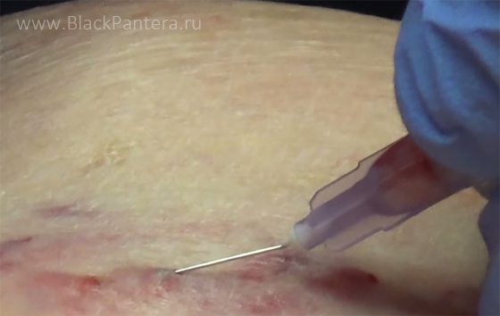 Пенная склеротерапия вен