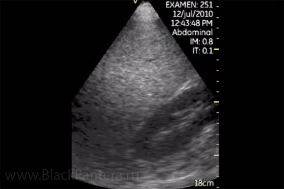 Диффузные изменения печени жировой гепатоз что это. УЗИ печени по типу жирового гепатоза. УЗИ жировая дистрофия печени беременных.