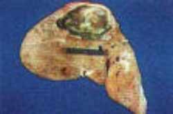 Echinococcus multilocularis - личинка цепня альвеококка Echinococcus multilocularis - личинка цепня альвеококка