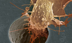 Онкология : в Европе рак становится эпидемией