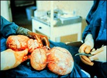 Echinoccocus granulosus – цепень эхинококк Echinoccocus granulosus – цепень эхинококк