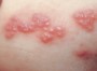 Какова локализация элементов сыпи у детей, инфицированных вирусом Herpes zoster? Какова локализация элементов сыпи у детей, инфицированных вирусом Herpes zoster?