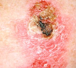 Вакцина от герпеса лечит рак кожи