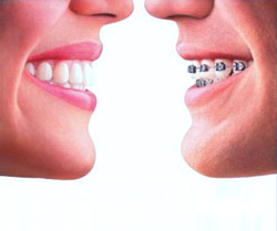     Invisalign