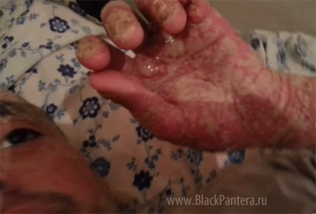 В Ирландии наблюдается рост заболеваемости псориазом В Ирландии наблюдается рост заболеваемости псориазом