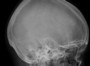 Является ли рентгенография черепа эффективным методом скрининга при травме головы у ребенка?