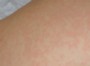 Каковы типичные признаки розеолы? Каковы типичные признаки розеолы?