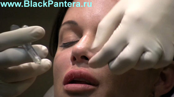 Следы от инъекций на губах 26juviderm.jpg