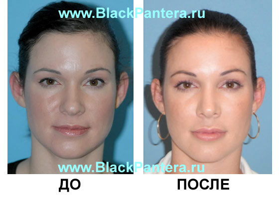 До и после Ювидерм Ультра doiposle-juviderm.jpg